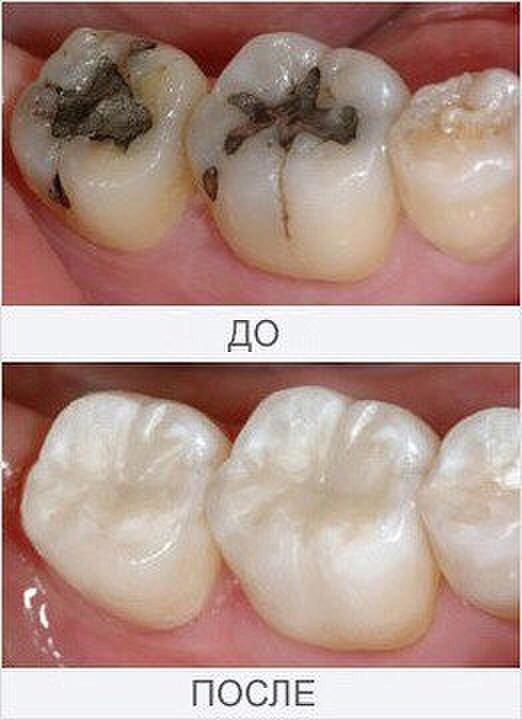 Лечение кариеса зубов и его осложнений пульпита и периодонтита