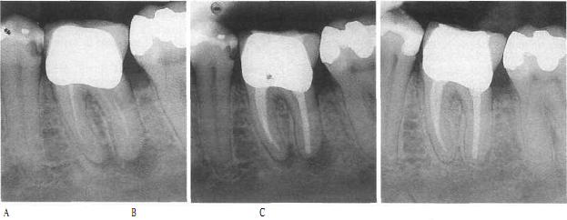 Лечение кариеса зубов и его осложнений пульпита и периодонтита